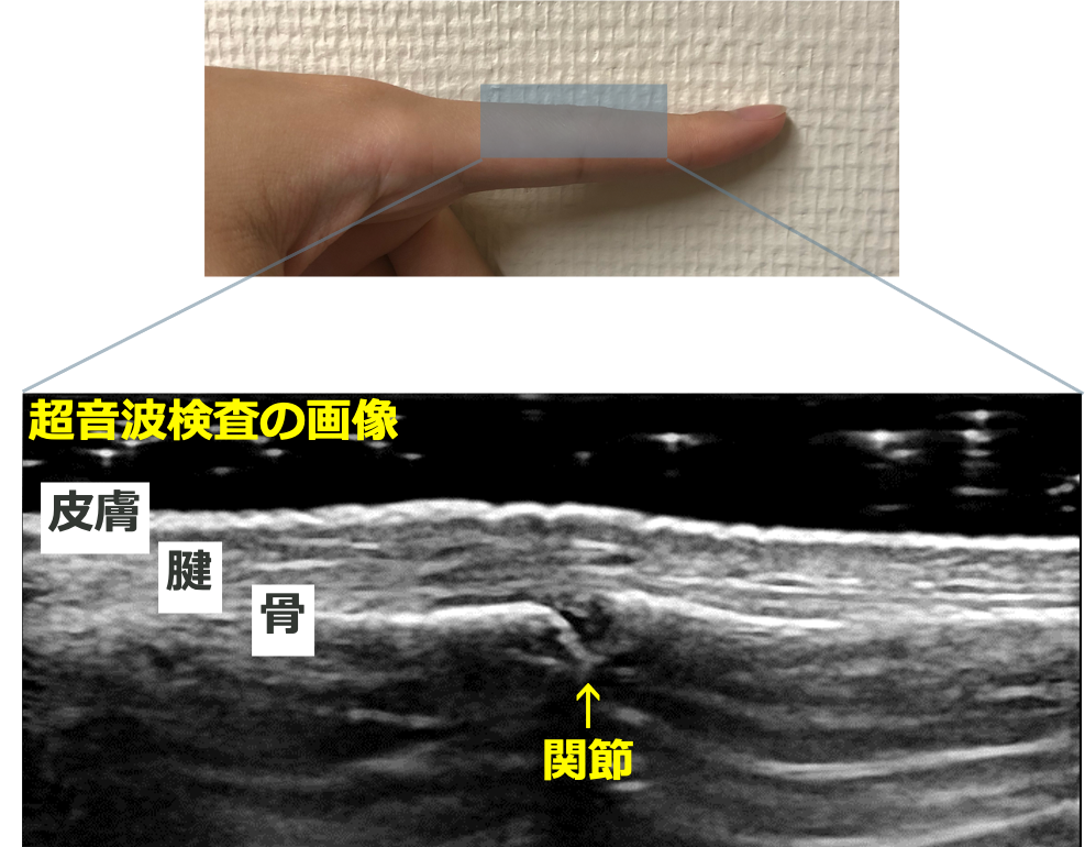 運動器エコー検査 | SERLA｜特定非営利活動法人 免疫・膠原病